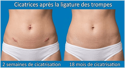 ligature des trompes – cicatrices
