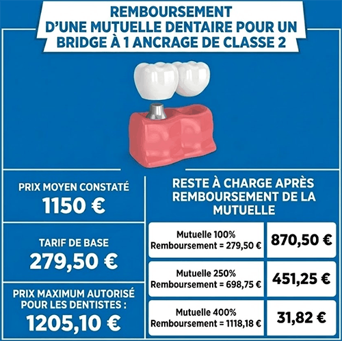 mutuelle dentaire remboursement prothèse