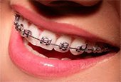 meilleure mutuelle orthodontie
