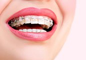 Surcomplémentaire santé orthodontie adulte et enfant